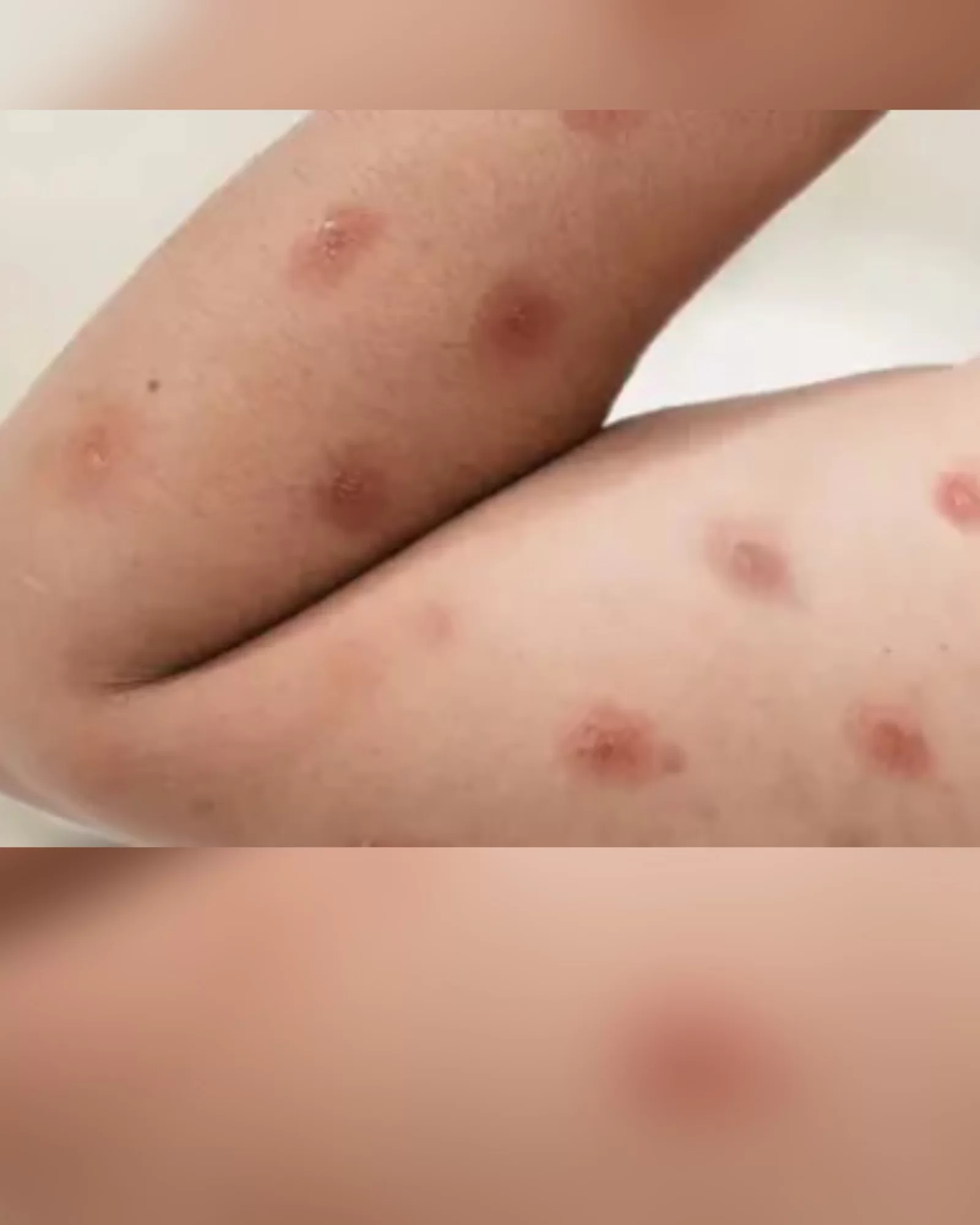 Ministério da Saúde confirma 88 casos de mpox no Brasil