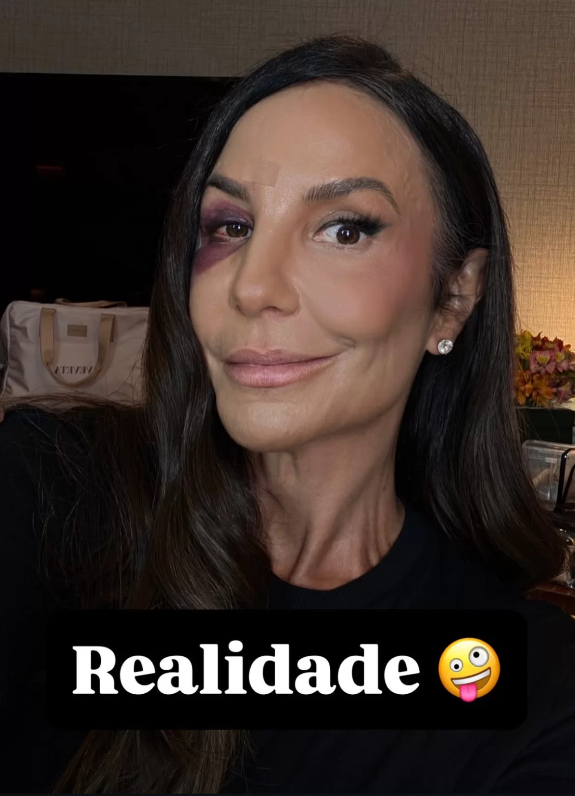 Após queda, Ivete Sangalo anuncia que passará por cirurgia neste domingo (1º