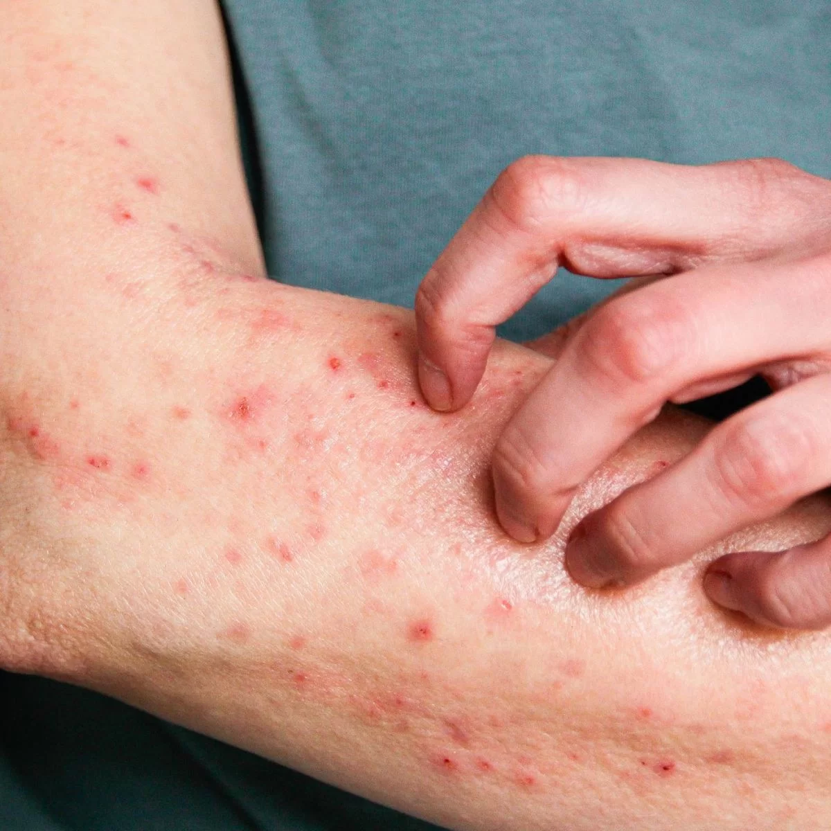 Ceará confirma primeiro caso de Mpox em 2026